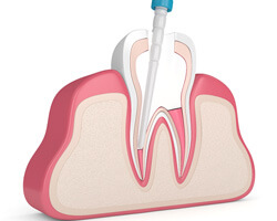 illustration of a root canal treatment in boston, ma