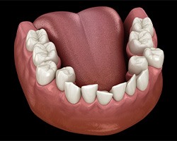 Illustration of crowded teeth