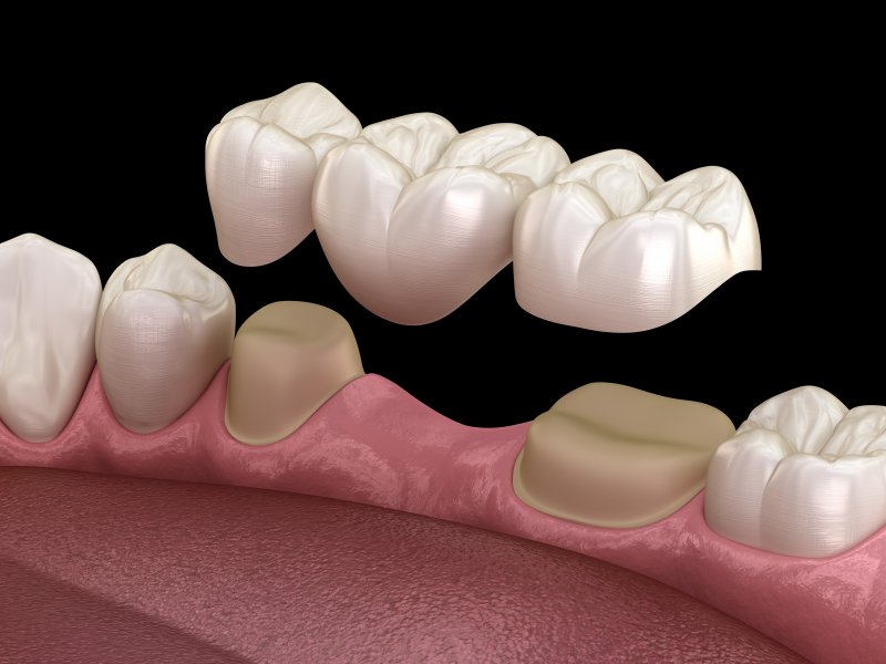 Digital illustration of a dental bridge